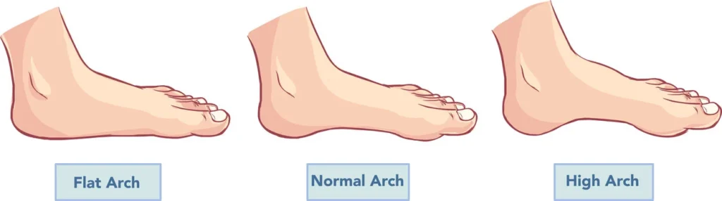 example of foot arch differences