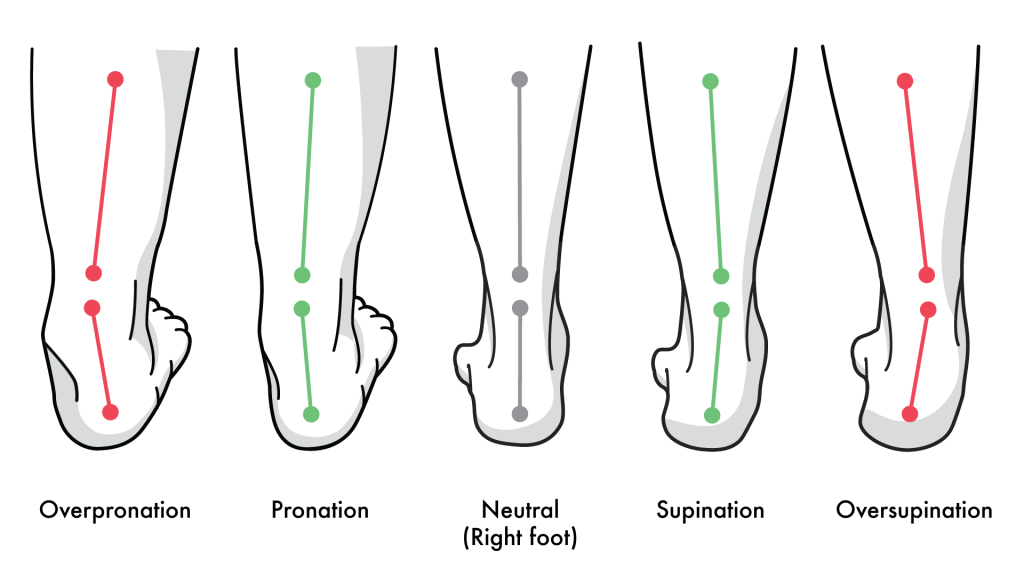 examples of foot pronation